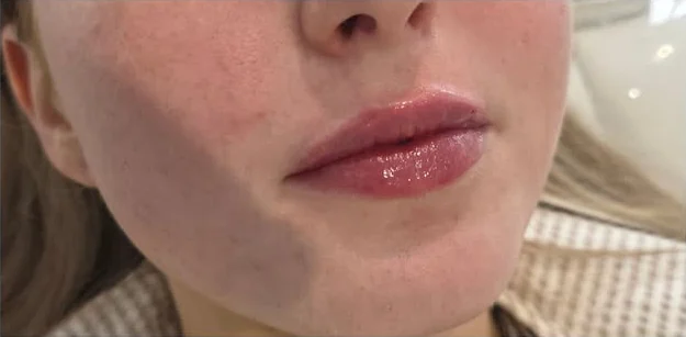 Lips after a first lip filler treatment, softly enhanced