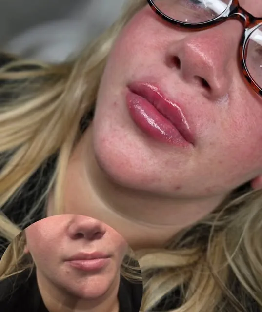 Before and after a lip filler treatment