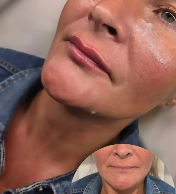 Before and after a natural lip enhancement